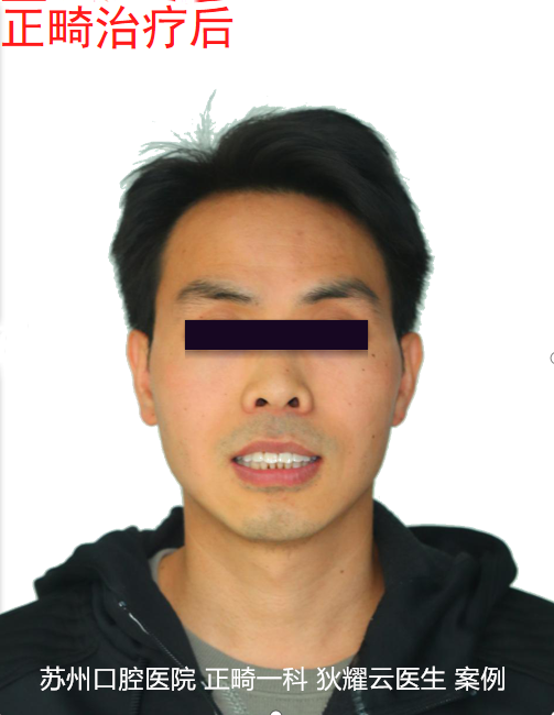 成年人矫正导致牙齿松动？成人矫正，到底难在哪？