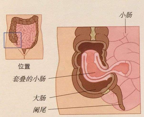 婴幼儿急腹症——肠套叠