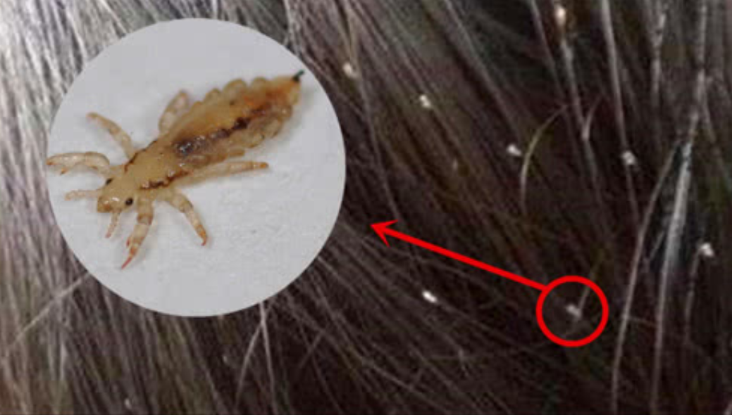 30年前人身上常见的虱子为何如今看不到了