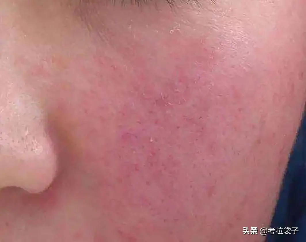 皮肤干燥过敏怎样处理（皮肤干燥过敏用什么护肤品）