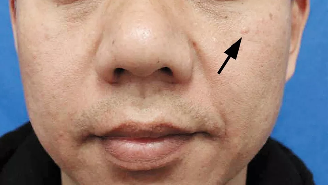 皮肤上的小肉球、小肉疙瘩是什么？不出意外，这4种可能性较大