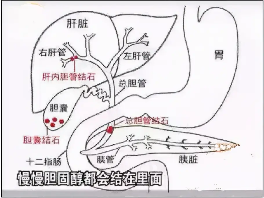 肝内胆管结石严重吗（肝内胆管结石怎么引起的）