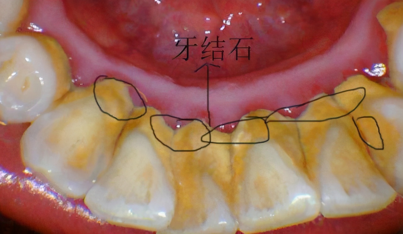 用手抠掉牙结石？医生劝你住手，用绝佳方法清除难道不香吗？