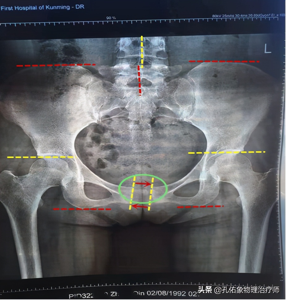 腰臀部疼或下肢麻木，是腰椎间盘突出吗？9种疾病需鉴别