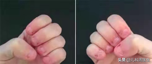 孩子“啃手指”不好改正，该让缺锌缺钙背锅吗？解决安全感很重要