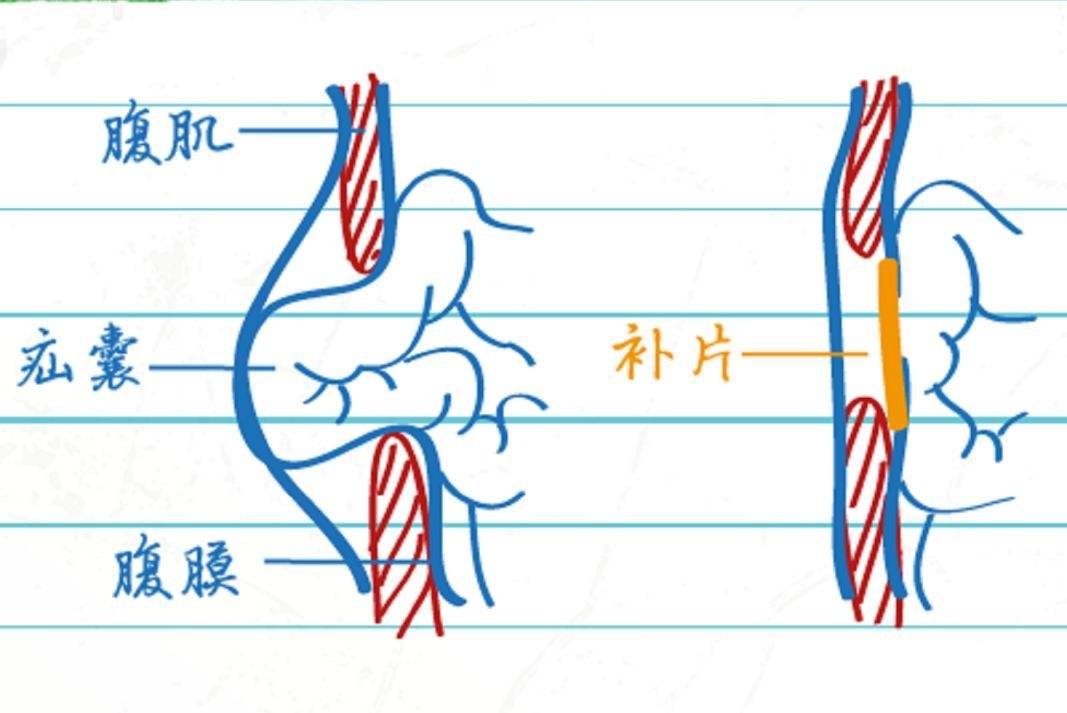 疝气是什么？它的治疗措施又是怎样的？