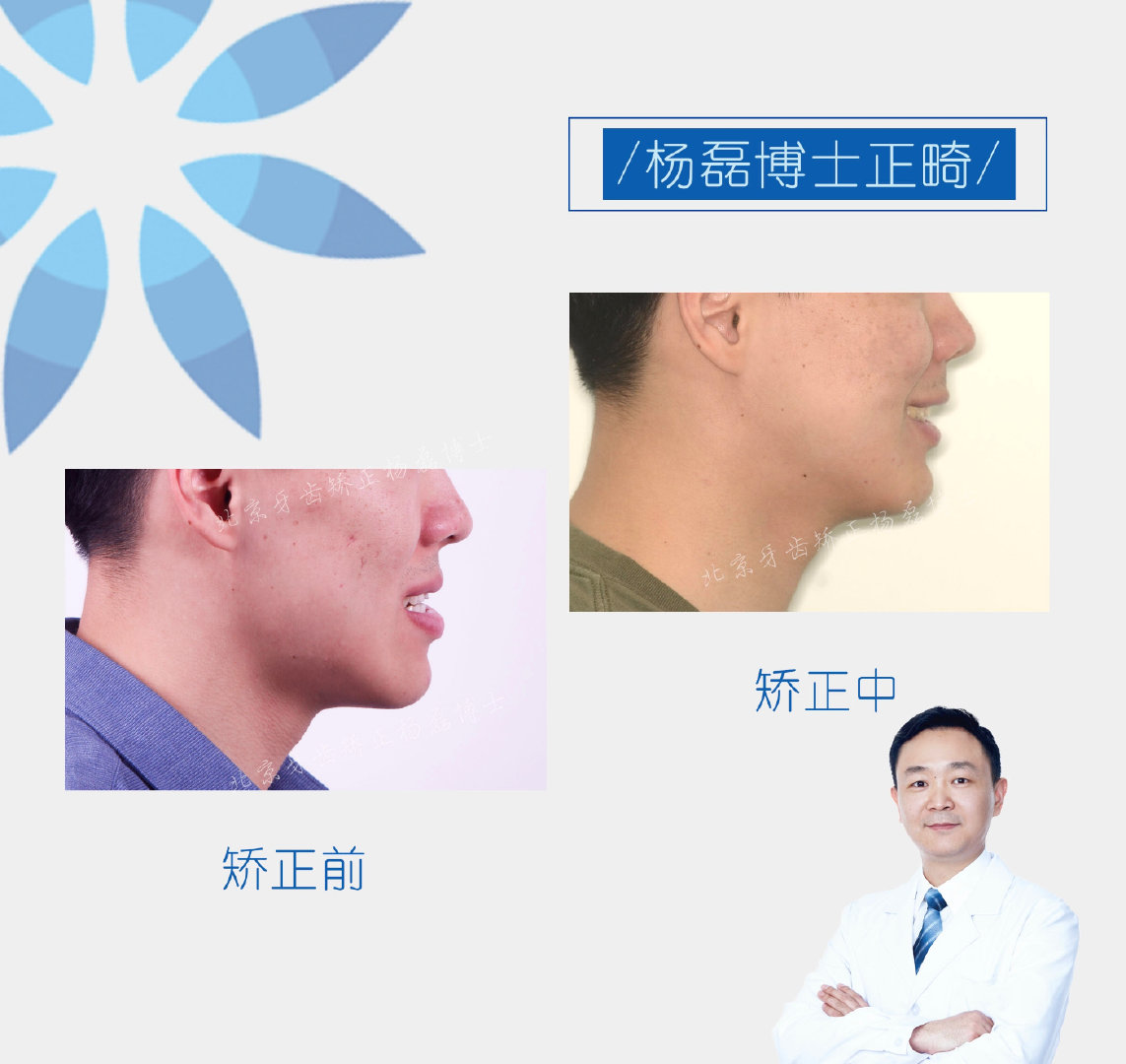 ​​杨磊博士 「骨性反颌偏颌正畸正颌联合治疗病例」