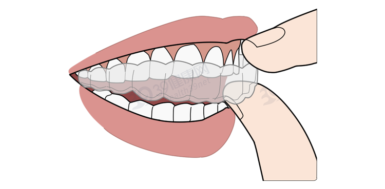 为什么只要戴牙套，牙齿就可以恢复得很整齐？生动展示矫正过程