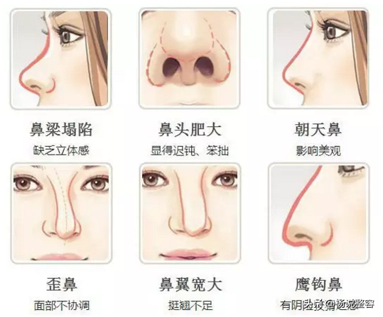 隆鼻整形：细讲隆鼻的利弊、风险与​隆鼻的效果持续性等问题