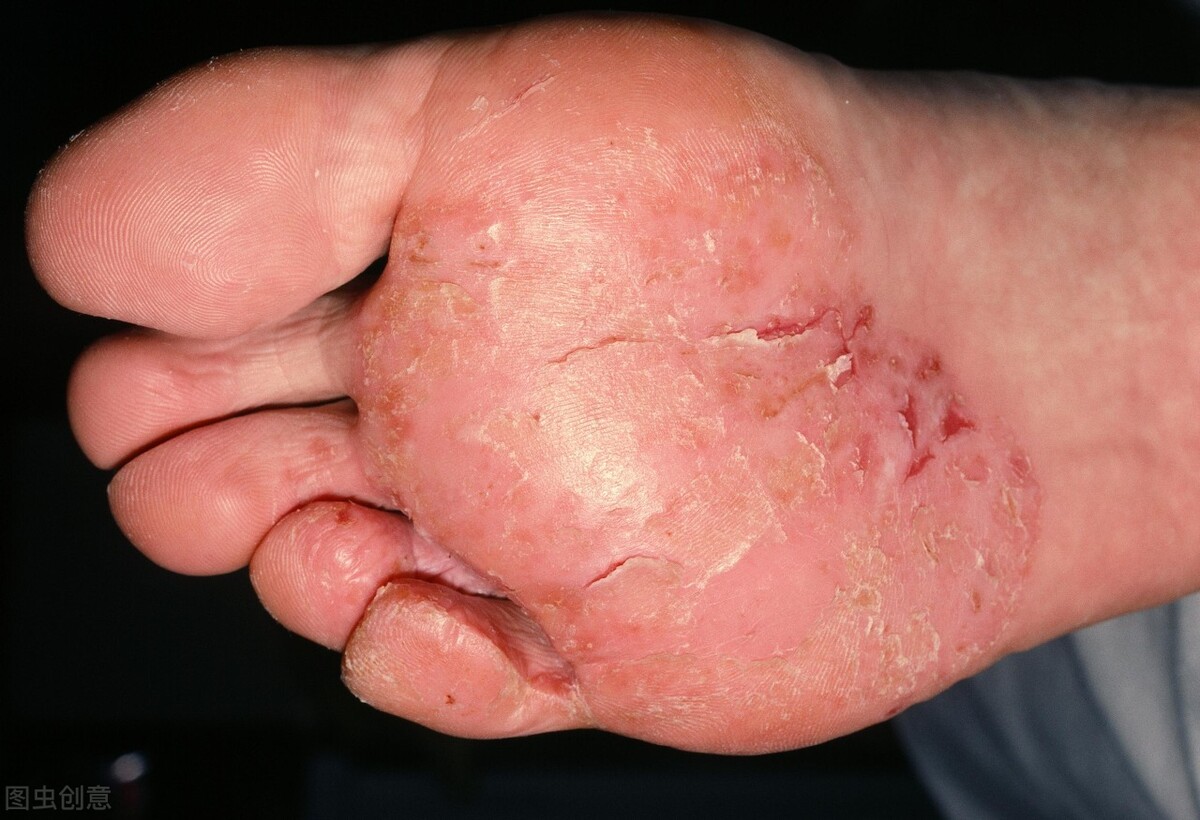 脚长湿疹症状图片图片