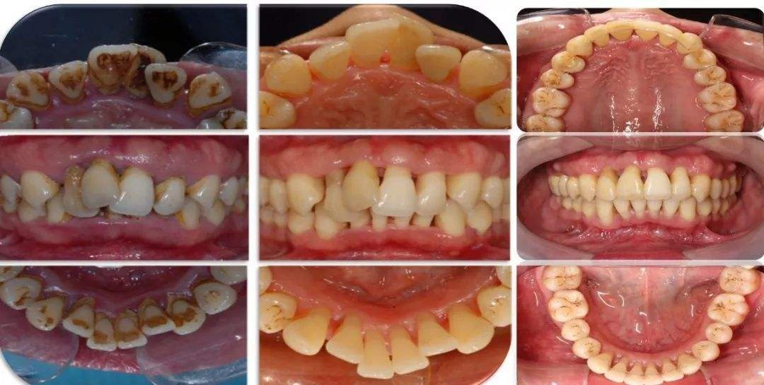 牙龈萎缩是怎么回事?如何预防?