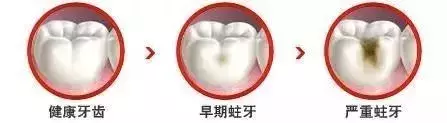 几十块钱就能补好的牙,久拖不治,以至要花上万,冤不冤?