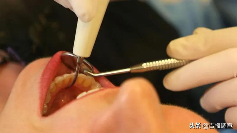 长了智齿到底拔不拔？长春市口腔医院专家给您支招啦