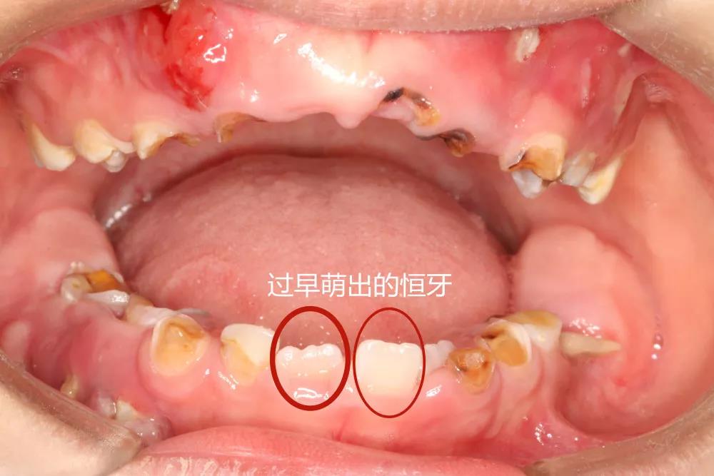 婴儿的妈牙是怎么回事(婴儿上牙膛白色一片怎么回事)-第1张图片-鲸幼网