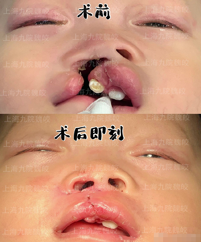 唇腭裂图片 唇腭裂患者如何进行修复？
