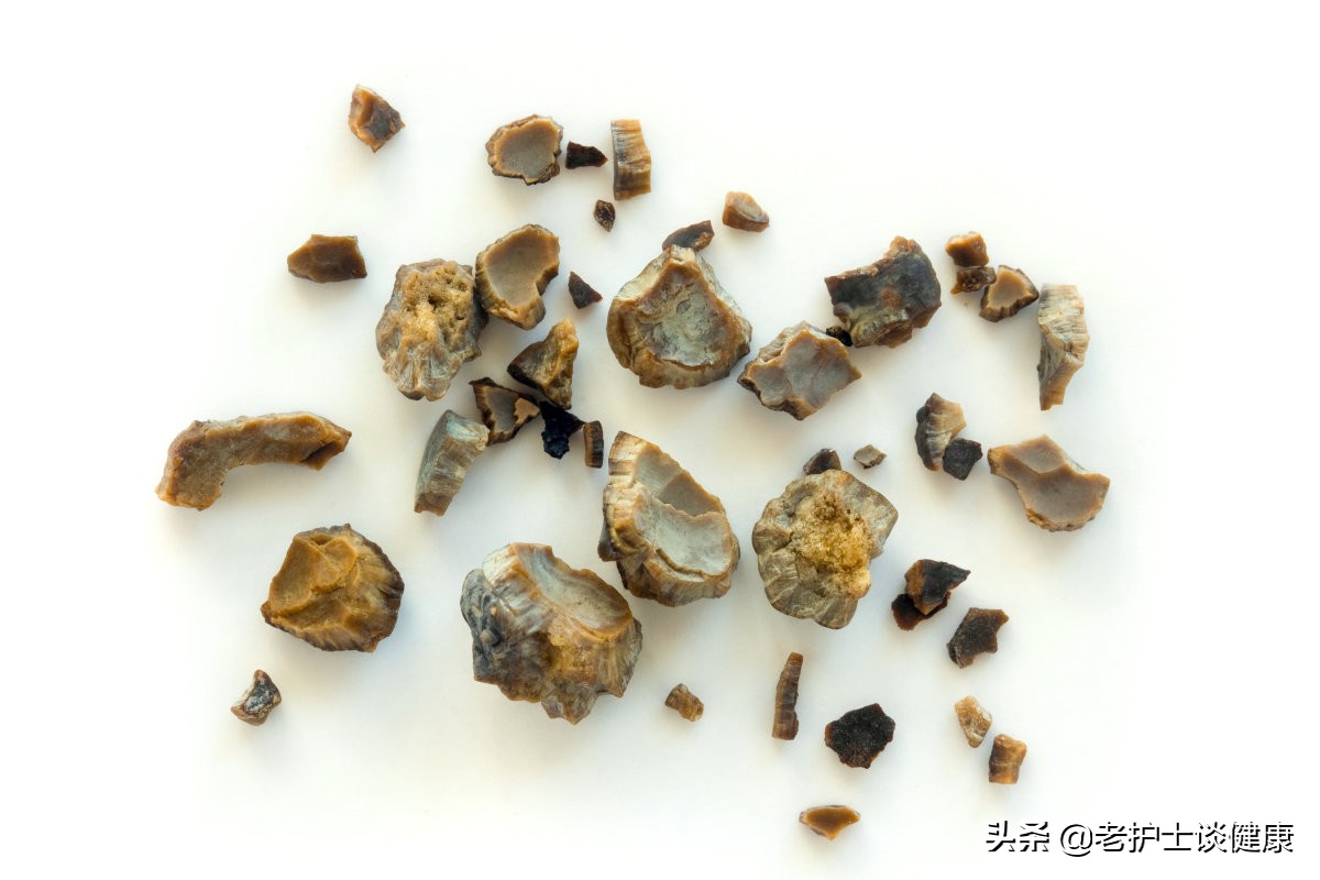肾结石引发剧烈疼痛和血尿的紧急处理方法