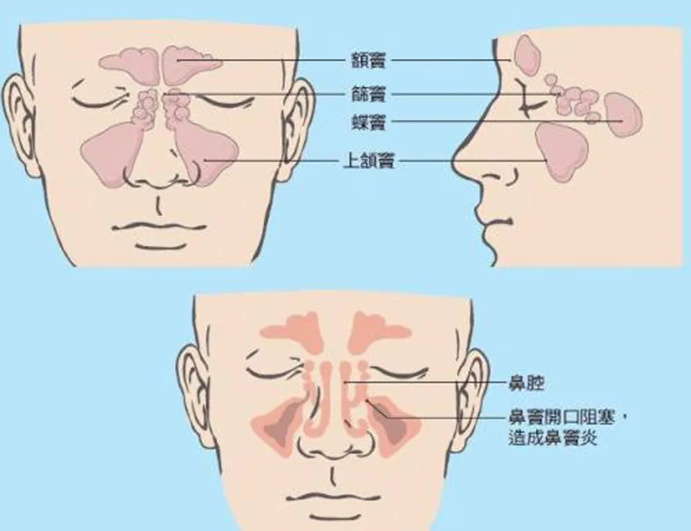 鼻窦炎和正常人的图片图片