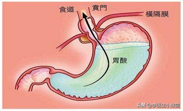 烧心反酸，反流性食管炎该怎么办？医生：这三类药物，效果极佳
