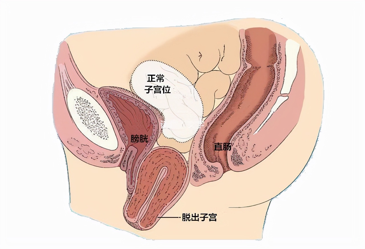 54岁阿姨跳广场舞太嗨，掉下来一块肉，医生：那是子宫