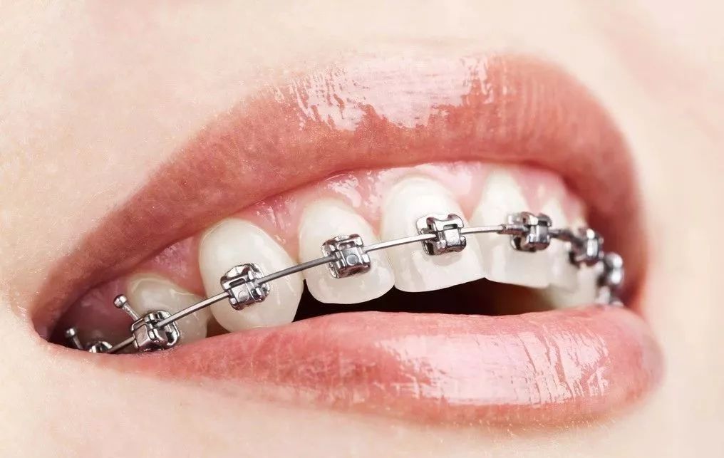 牙齿矫正最低多少钱？