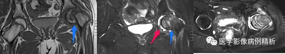 垂体柄阻断综合征并股骨头骨骺滑脱MR典型影像表现及分析思路