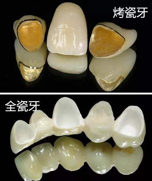全瓷牙和烤瓷牙的区别到底在哪？为什么医生都推荐做全瓷牙？