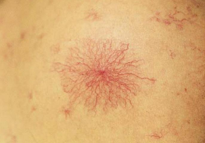 这也就导致了血液中的胆红素增加从而引起黄疸,不仅皮肤全是发黄,尿液