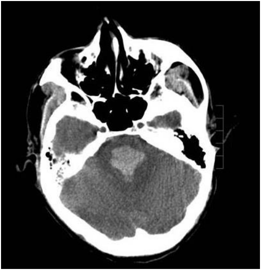 37岁的脑干出血