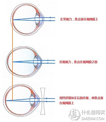 近视眼镜购买攻略之镜片