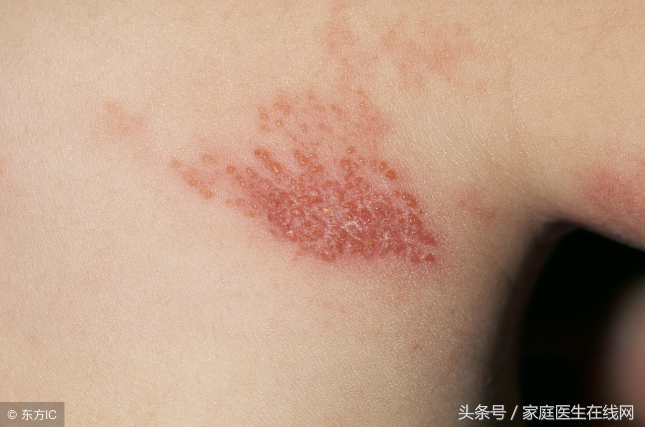 脖子丝状疣的病因及皮肤科治疗方法