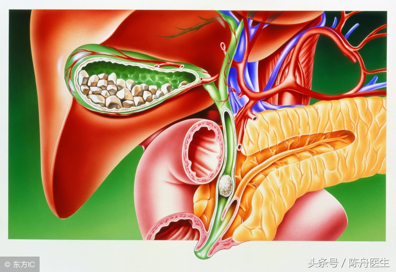 15.胆结石5mm左右，吃药能把石头化解排掉吗？