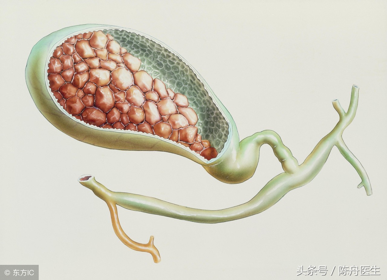 15.胆结石5mm左右，吃药能把石头化解排掉吗？