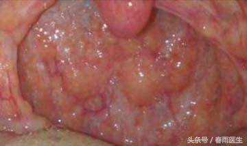 宝宝总说嗓子里有东西，也许是淋巴滤泡的问题