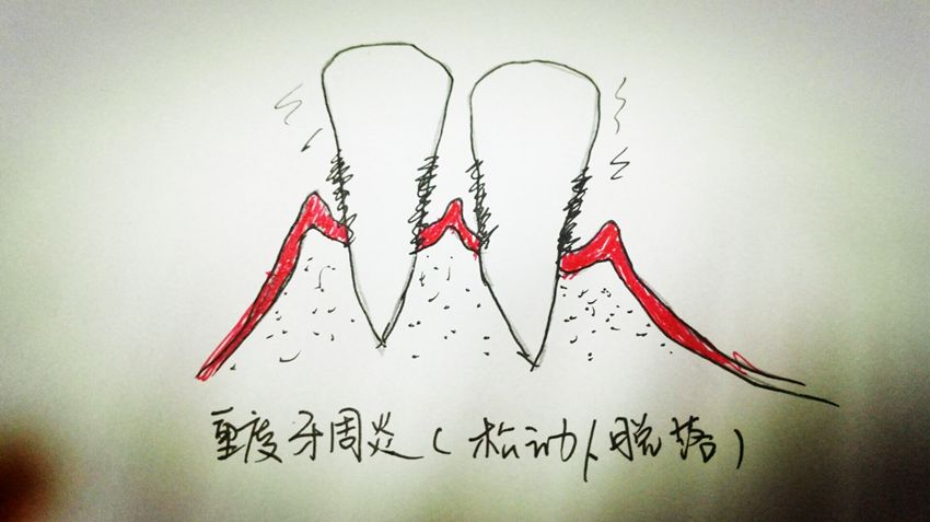 正畸期间牙根暴露？