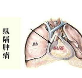 纵膈子宫不是疑难杂症，了解这些其实并不可怕