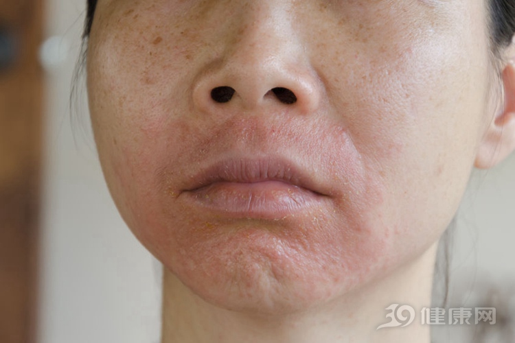 脸部过敏特别痒怎么办?教你4个快速解决过敏的小窍门