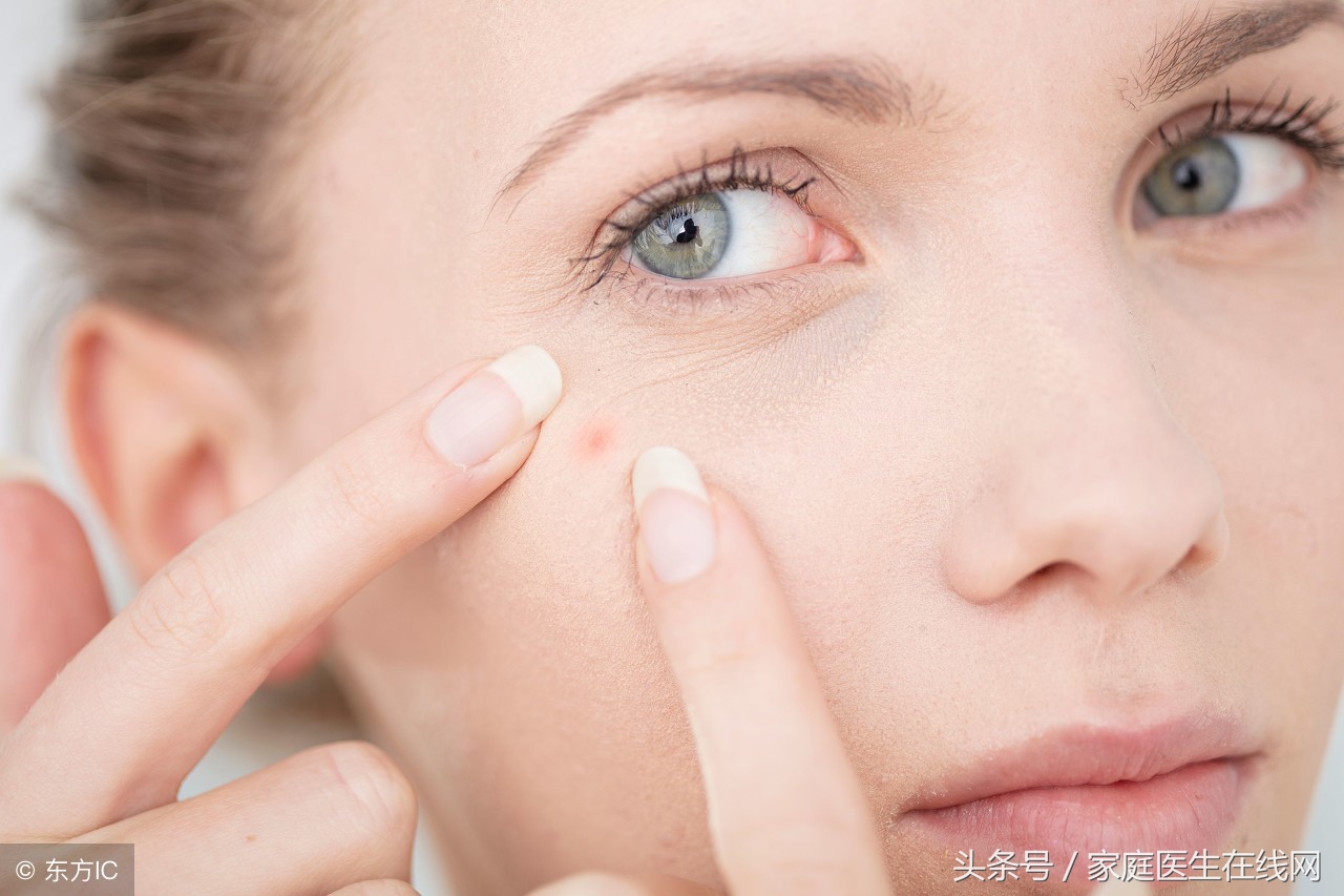 为什么脸上老是长痘？看看是不是做错了这6件事