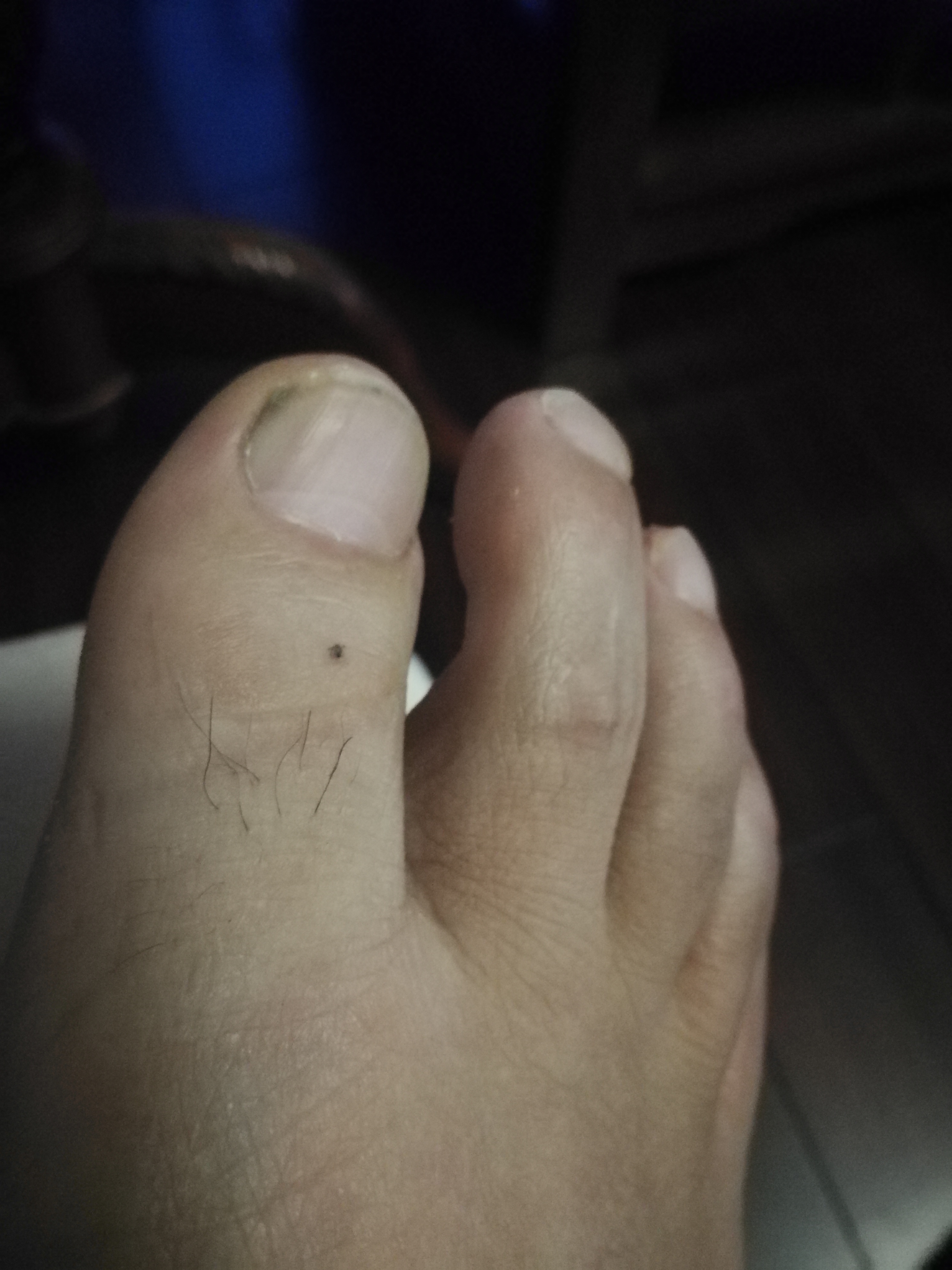 相术:图解——脚上长痣