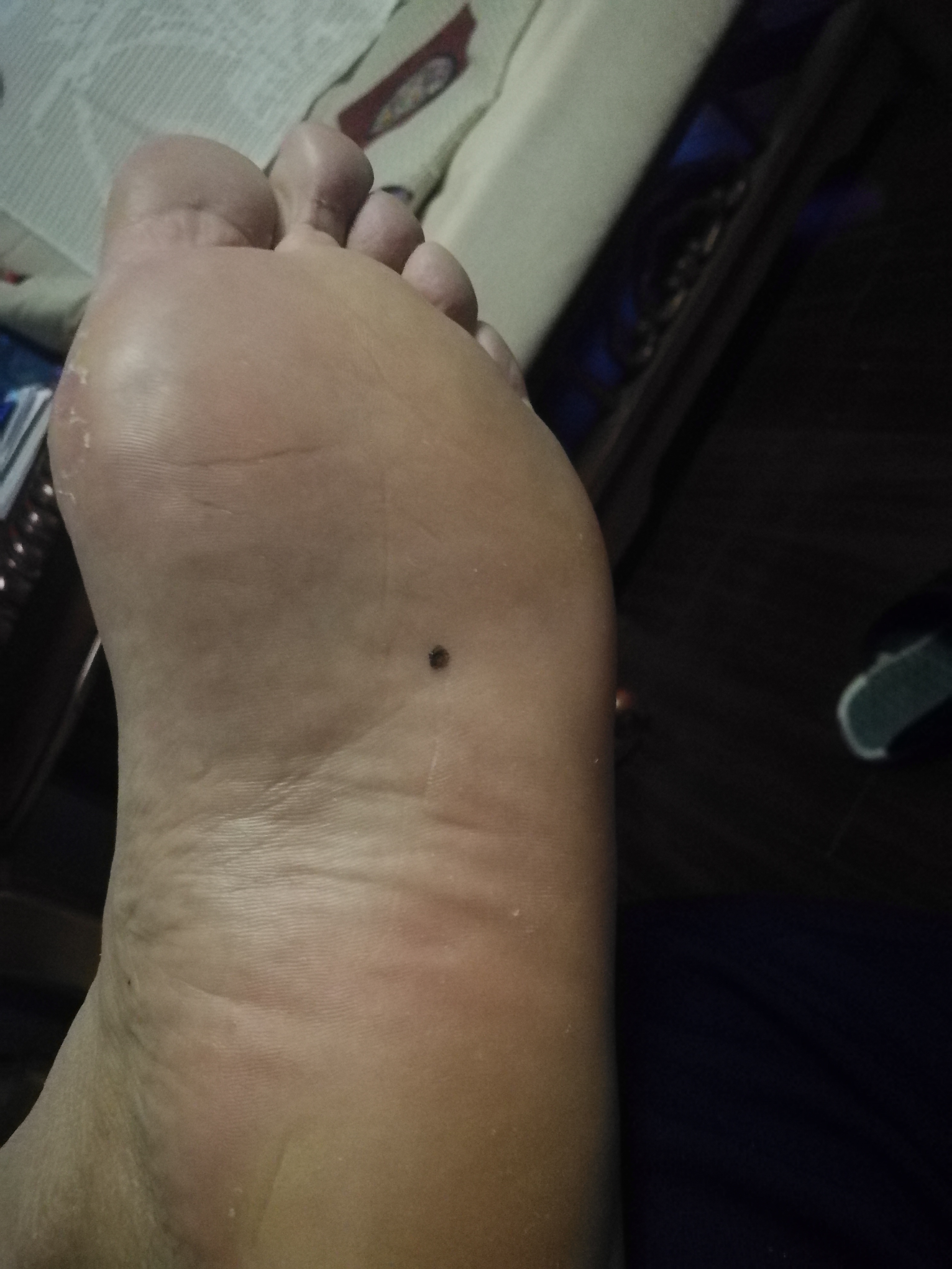 相术:图解——脚上长痣