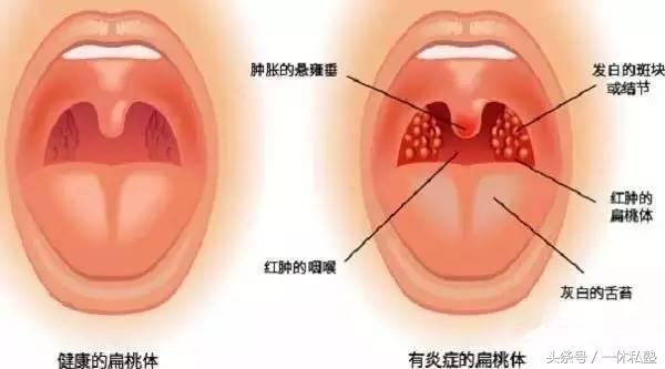 扁桃体发炎最怕一碗水 扁桃体反复发炎怎么办