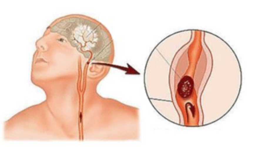脑动脉狭窄导致脑梗怎么办？血管支架不是万能