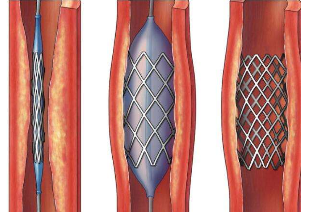 脑动脉狭窄导致脑梗怎么办？血管支架不是万能