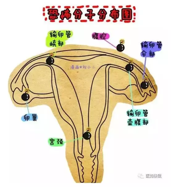女子腹痛12小时死亡,竟因宫外孕!怀孕后出现这些症状要当心!