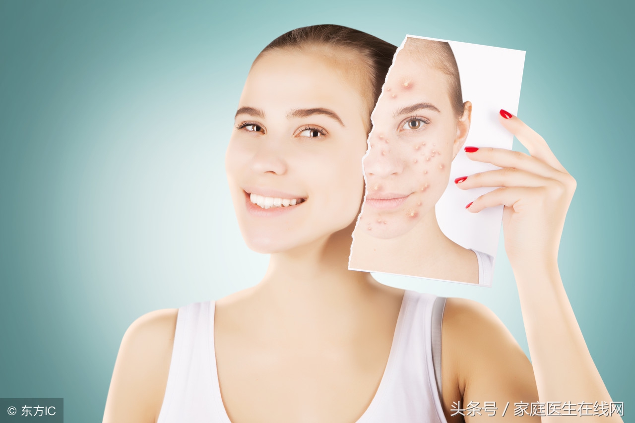 痤疮如何治疗？皮肤科主任：先别傻傻的犯这6个错