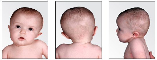 婴儿偏头长大的样子图图片