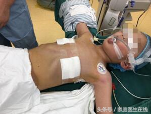 5岁童体检发现漏斗胸，医生用这个方法，让患儿重新挺起胸膛