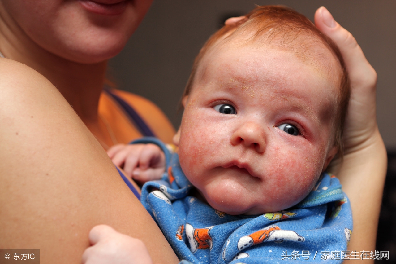 婴儿干燥性湿疹图片（宝宝湿疹反复发作）-幼儿百科-魔术铺