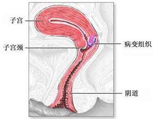 HPV检测如何进行？了解筛查方法预防宫颈癌