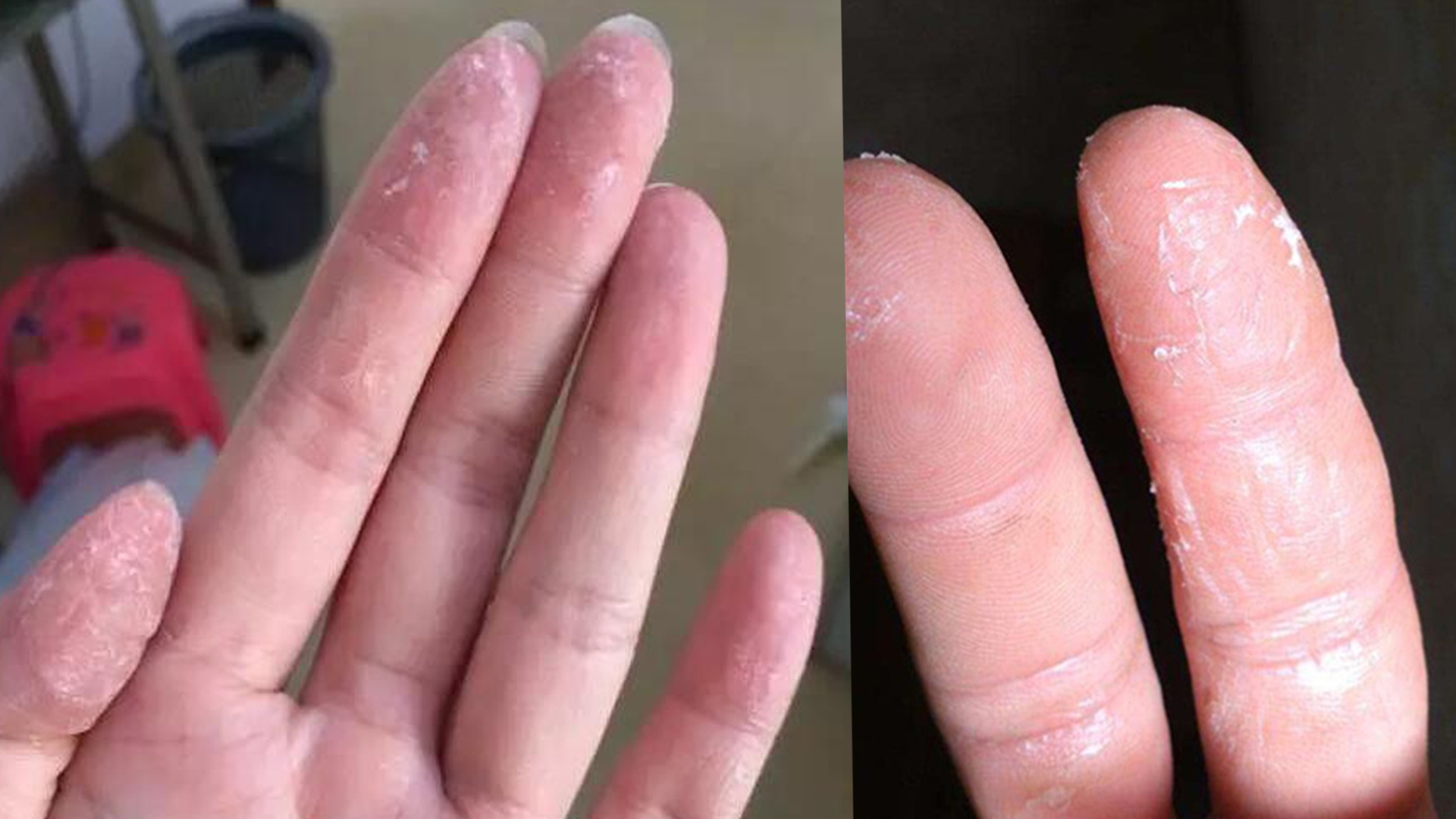 502胶水怎么去除手上502胶水怎么去除手上风油精