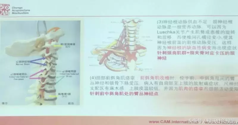 参加程氏针灸培训班，菜鸟学以致用见成效